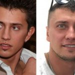 Pavel Priluchny ear plastic surgery