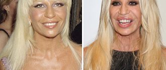 Victims of plastic surgery